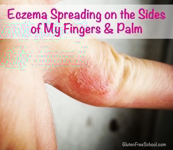 can gluten affect your skin